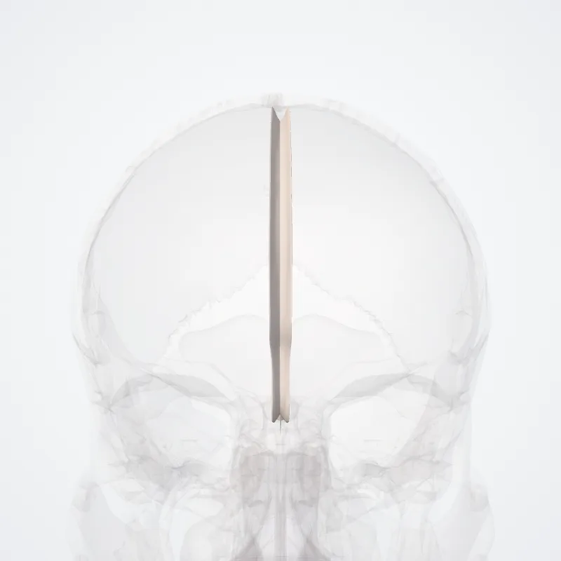 Falx cerebri highlighted in a 3D model of the human body
