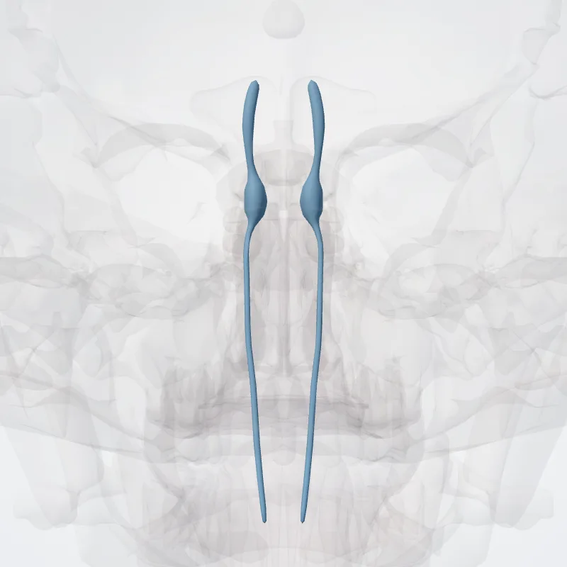 Radix sensoria nervi trigemini (Sensory root of trigeminal nerve) hervorgehoben in einem 3D-Modell des menschlichen Körpers
